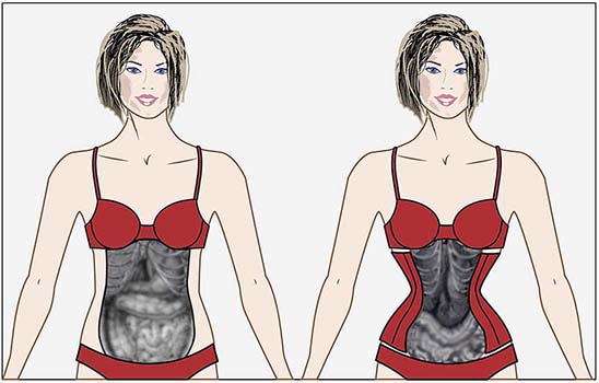 Воздействие корсета